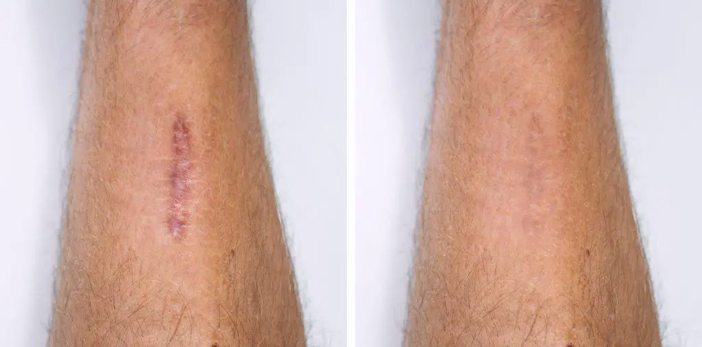 A scar shown when first healing and after fading